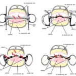 Le bitless ou bridon sans mors